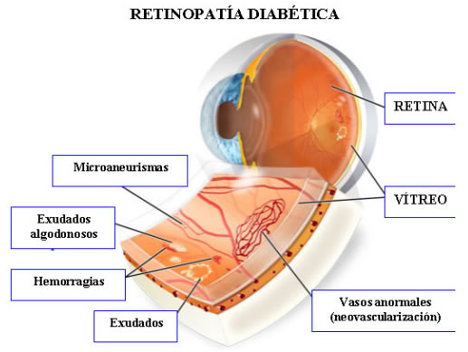 Retinopathia diabéteszes szemkezelés