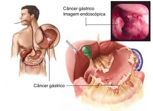 Cancer-gastrico