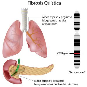 Fibrosis-Quistica