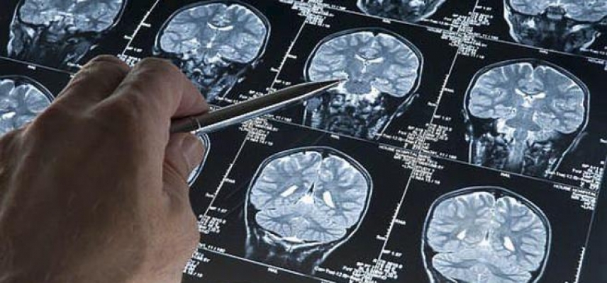 La diabetes y su relación con la demencia
