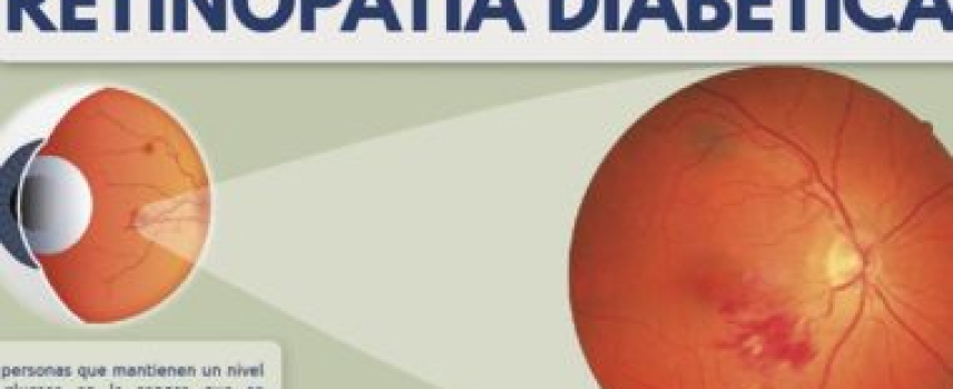 Factores que influyen en la retinopatía diabética