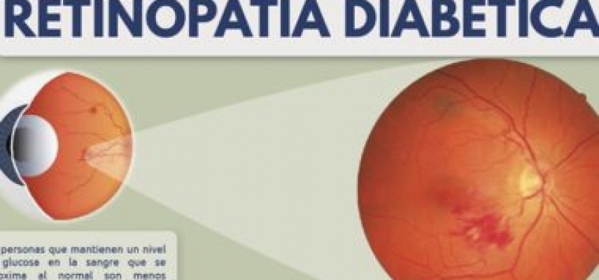 Factores que influyen en la retinopatía diabética