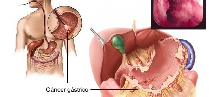 Nuevos hallazgos en cáncer gástrico