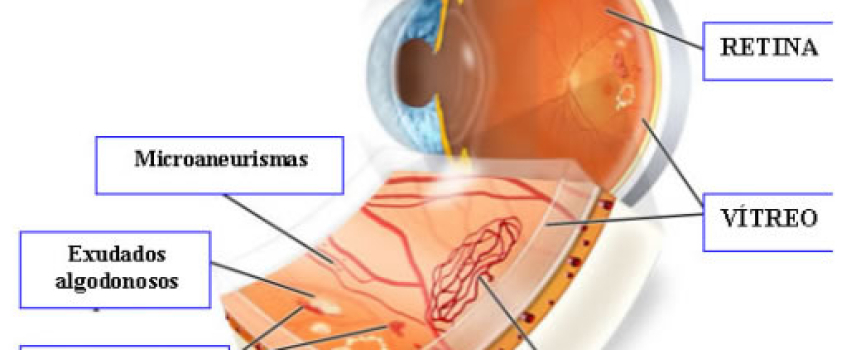 Complicaciones de los ojos
