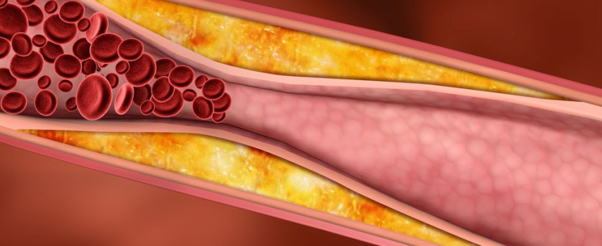 Dislipidemia en aumento por obesidad