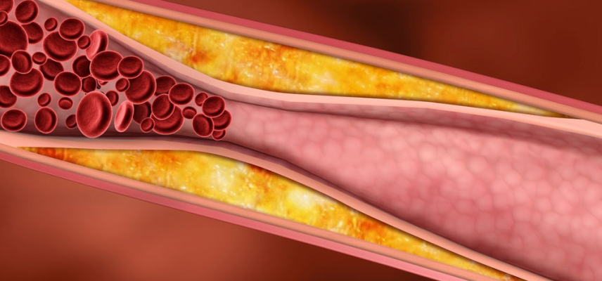 Dislipidemia en aumento por obesidad