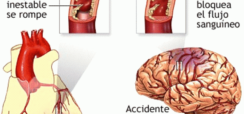 ¿Las bombas de insulina pueden reducir el riesgo de muerte por problemas cardiacos?