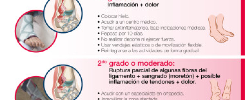 Esguince: A todos nos pasa pero no sabemos qué hacer