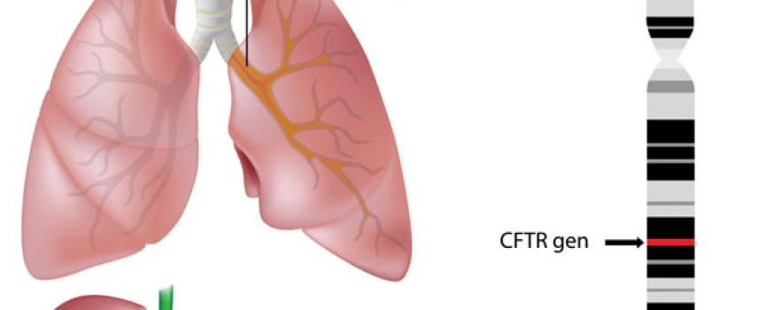 El camino para combatir la Fibrosis Quística en México