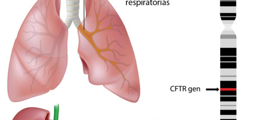 El camino para combatir la Fibrosis Quística en México
