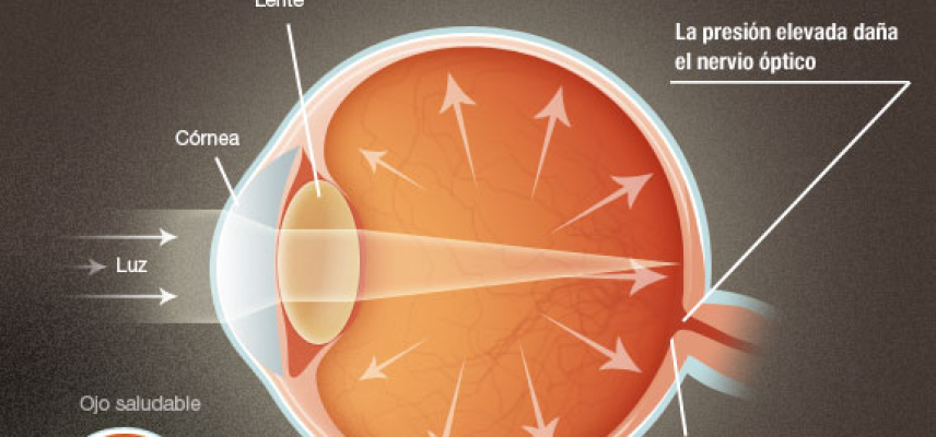 Interacción genética en el desarrollo de glaucoma