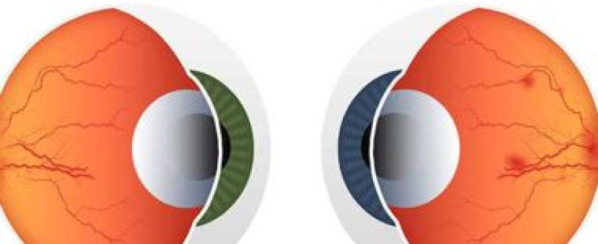 En riesgo de presentar retinopatía diabética y ceguera 4 de cada 10 pacientes con diabetes