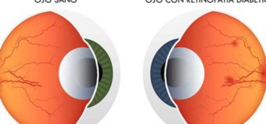 En riesgo de presentar retinopatía diabética y ceguera 4 de cada 10 pacientes con diabetes