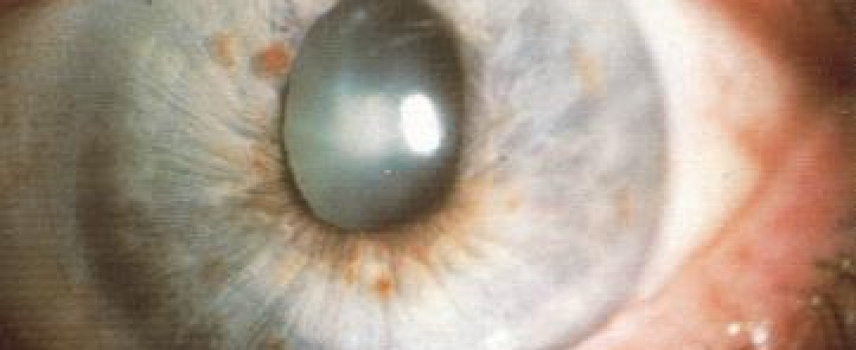 Diabetes y Glaucoma: Contrólalos a tiempo