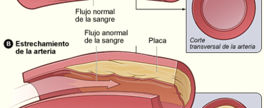 Enfermedad de las arterias coronarias