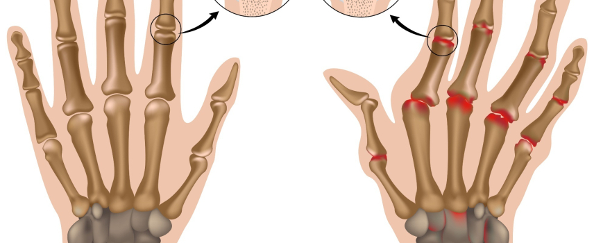 ¿Qué es la Artritis reumatoide?