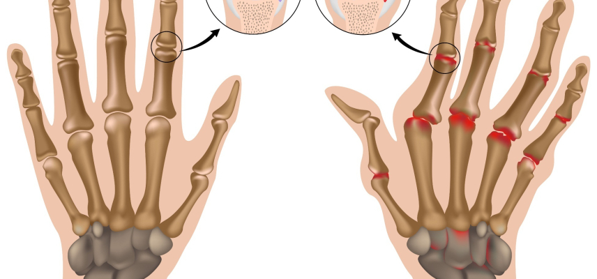 ¿Qué es la Artritis reumatoide?