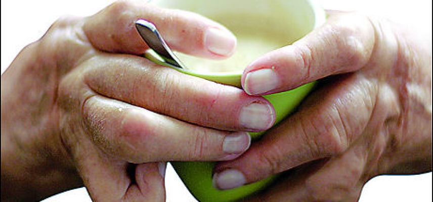 Obesidad y el riesgo de Artritis Reumatoide