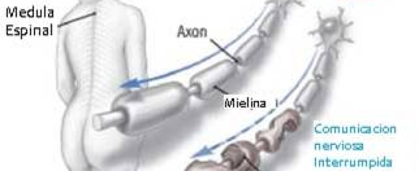 Provoca Esclerosis Múltiple discapacidad neurológica a más de 15 mil mexicanos