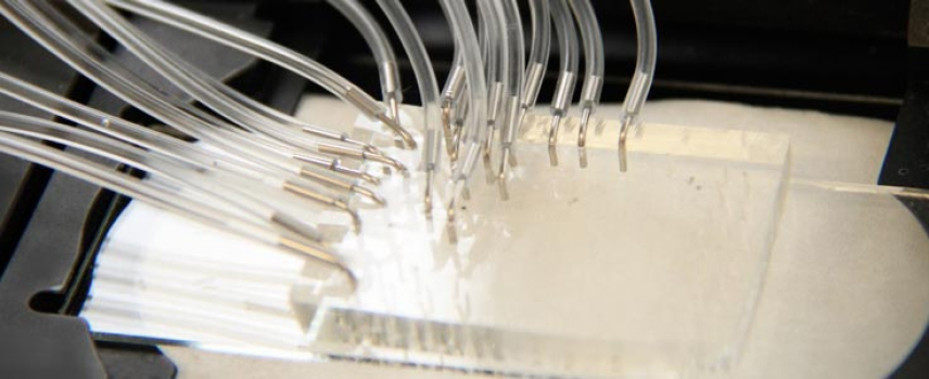 Biochip para pacientes con lupus