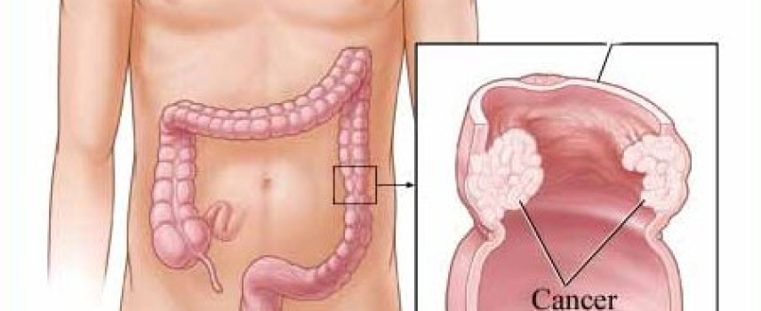 Cáncer colorrectal en México