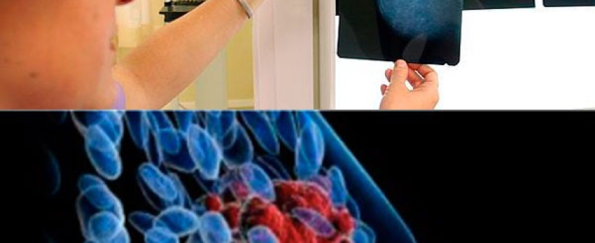Bioinformática y radiología para detectar cáncer de mama