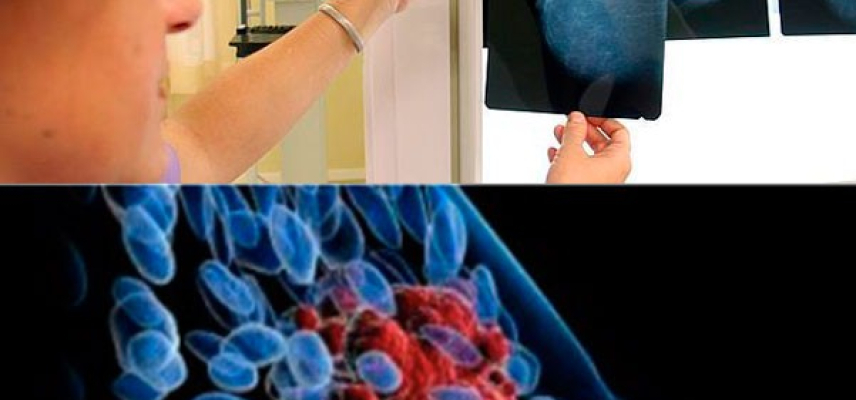 Bioinformática y radiología para detectar cáncer de mama