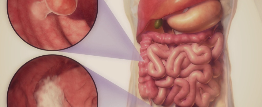 Desarrollan terapia para cáncer colorrectal que ofrece más y mejor expectativa de vida