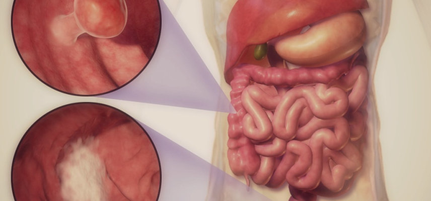 Desarrollan terapia para cáncer colorrectal que ofrece más y mejor expectativa de vida