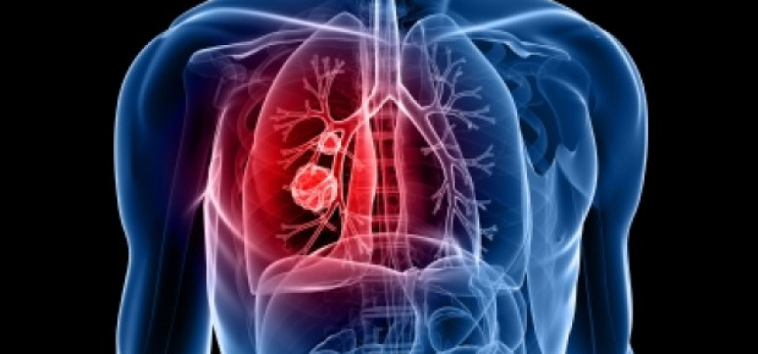 Nueva terapia para cáncer de pulmón