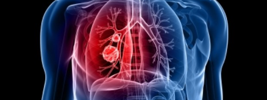 Nueva terapia para cáncer de pulmón