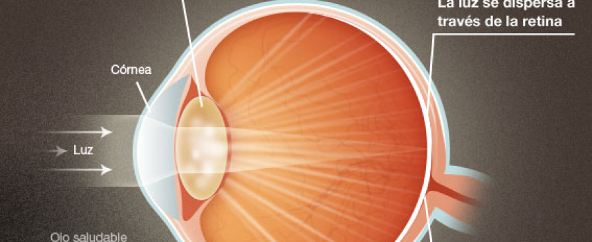 Alteraciones oculares por diabetes