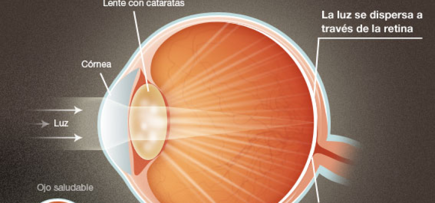 Alteraciones oculares por diabetes