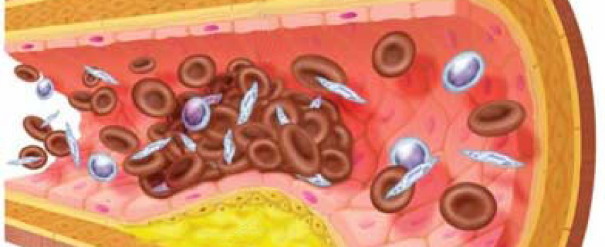 Aumentan riesgos cardiacos en pacientes con diabetes