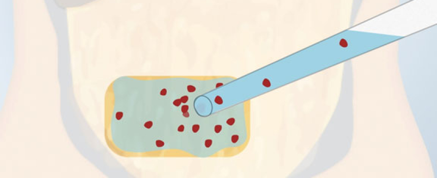 Una cura para la diabetes tipo 1 podría estar cerca