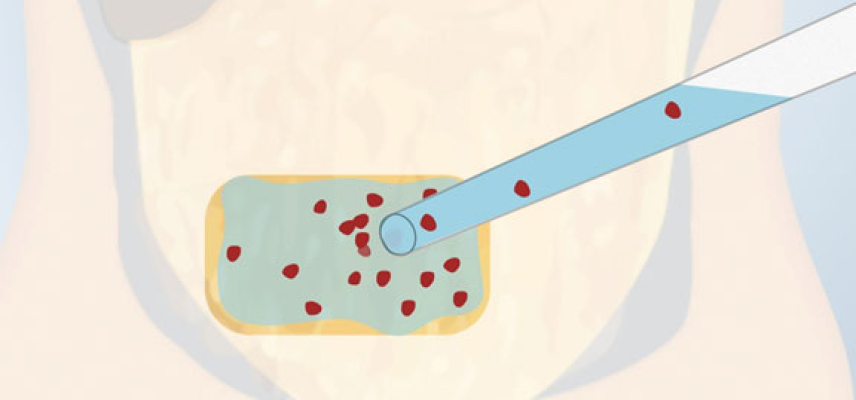 Una cura para la diabetes tipo 1 podría estar cerca