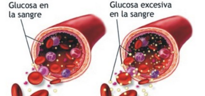Niveles altos de glucosa en sangre