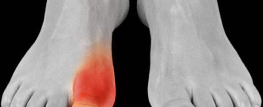 La dieta es importante para prevenir y tratar la enfermedad de la gota