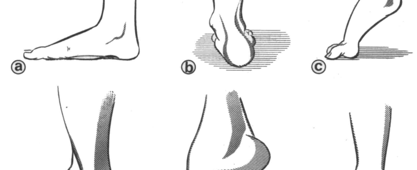 Diabetes y pié de Charcot
