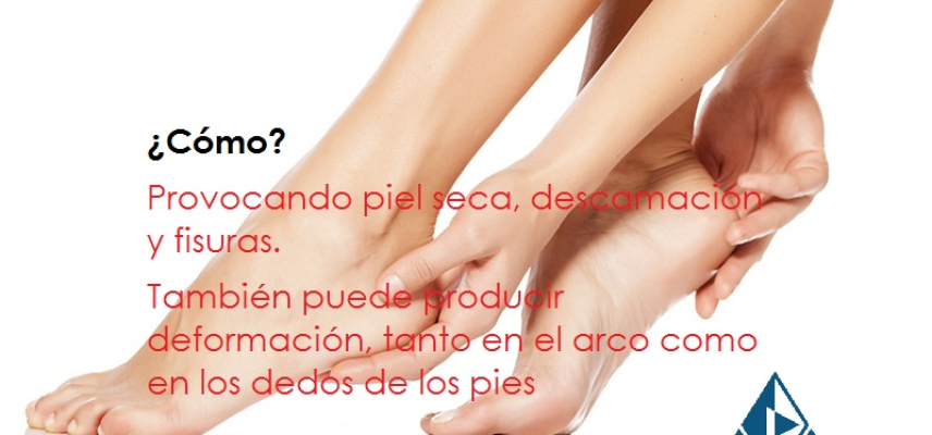 La Neuropatía en la diabetes y el daño en los pies