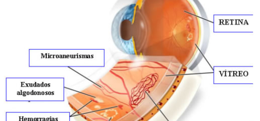Tratamiento de la Retinopatía Proliferativa