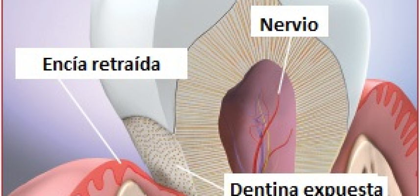 Sensibilidad dental – afecta al 47% de los mexicanos