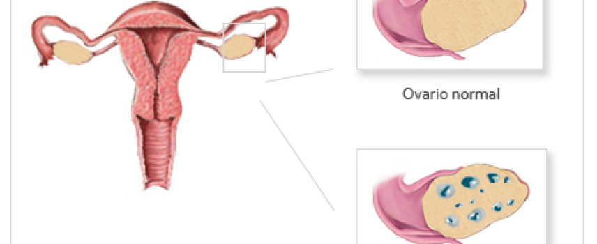 Síndrome del ovario poliquístico (SOP)