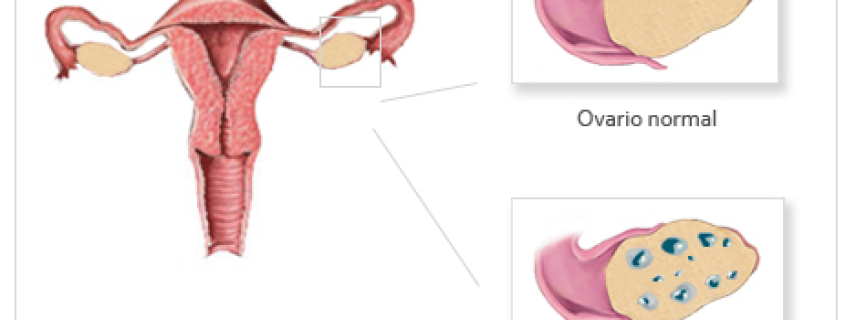Síndrome del ovario poliquístico (SOP)