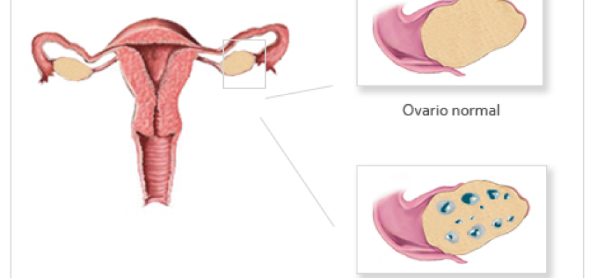 Síndrome del ovario poliquístico (SOP)