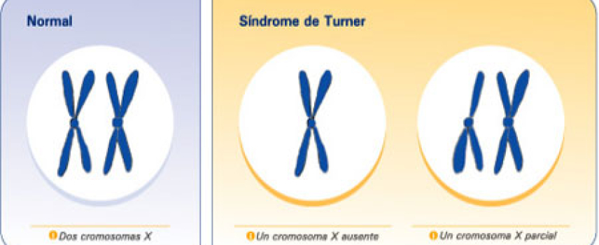 ¿Qué es el síndrome de Turner?