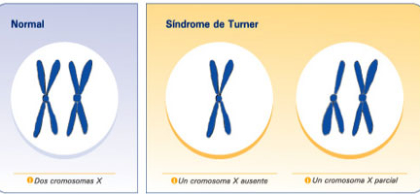 ¿Qué es el síndrome de Turner?