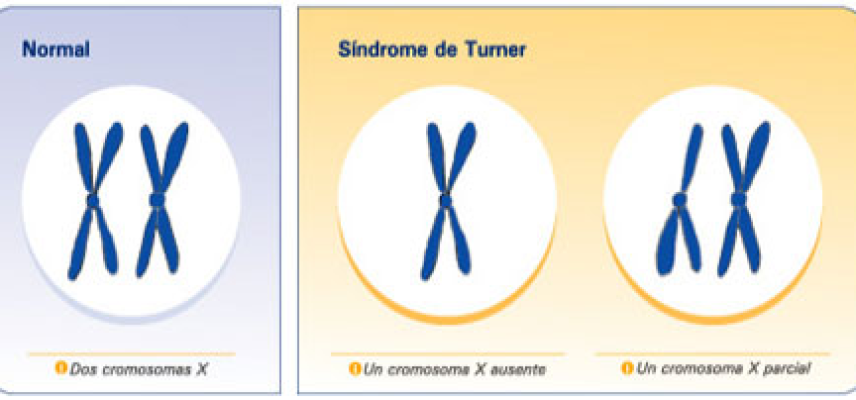 ¿Qué es el síndrome de Turner?