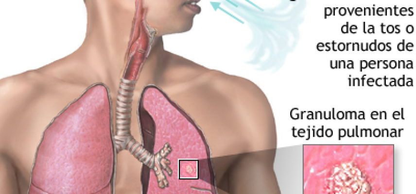Estudian propiedades de Vitamina C para tratar tuberculosis y diabetes